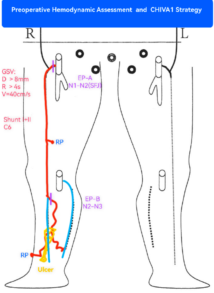 Preoperative hemodynamic assessment and CHIVA1 strategy based on duplex ultrasound mapping.